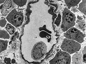 celiakia- plasmocellular infiltrationof lamina propria celiakia- plasmocellular infiltrationof lamina propria